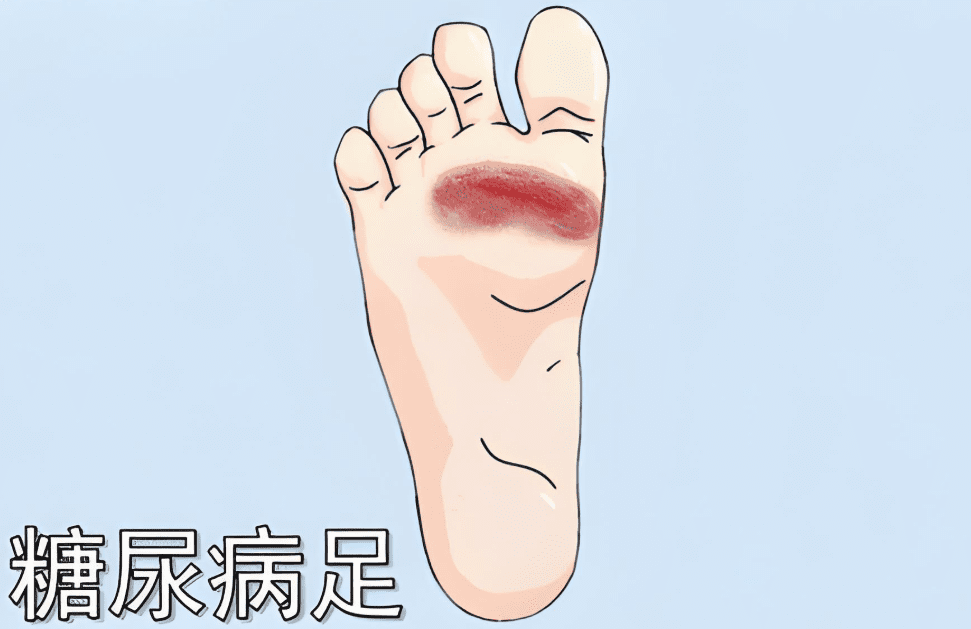 糖尿病足部潰瘍