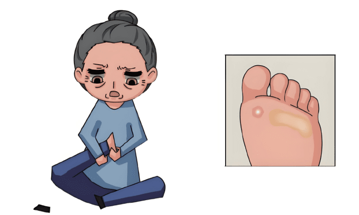 糖尿病症狀腳潰瘍